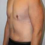 Gynecomastia Before & After Patient #930