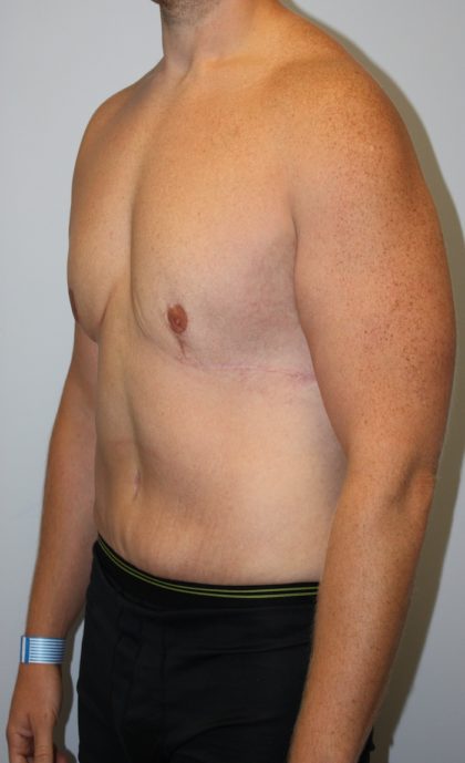 Gynecomastia Before & After Patient #930