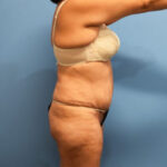 Tummy Tuck Before & After Patient #769