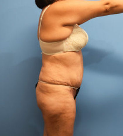 Tummy Tuck Before & After Patient #769