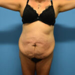 Tummy Tuck Before & After Patient #746