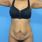 Tummy Tuck Before & After Patient #774