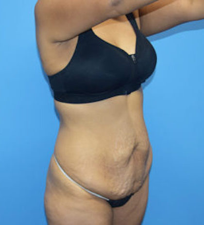 Tummy Tuck Before & After Patient #774