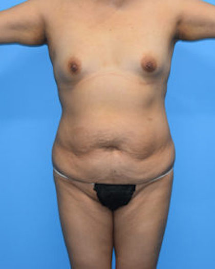 Tummy Tuck Before & After Patient #763