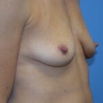 Breast Augmentation Before & After Patient #848