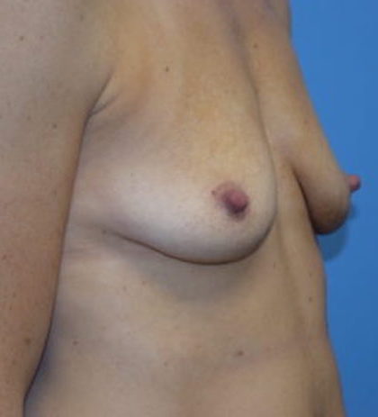 Breast Augmentation Before & After Patient #848