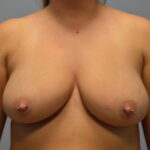 Breast Augmentation Before & After Patient #858