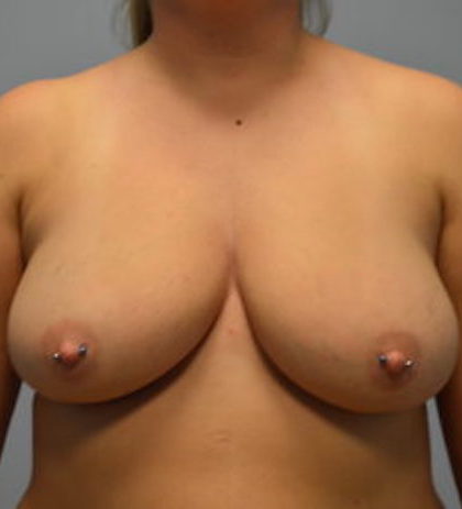 Breast Augmentation Before & After Patient #858