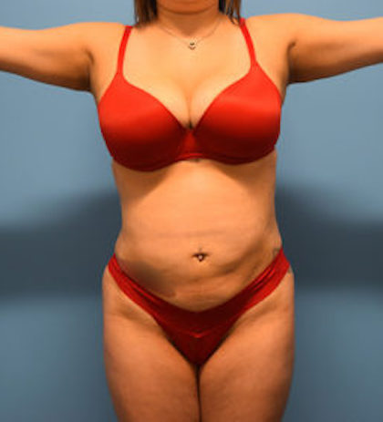 Liposuction Before & After Patient #934