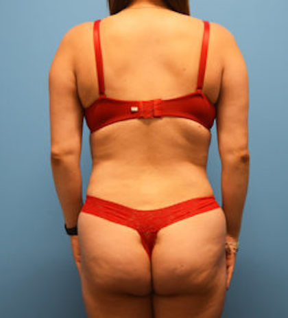 Liposuction Before & After Patient #934