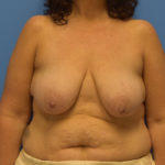 Breast Lift Before & After Patient #905