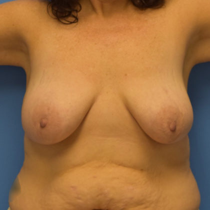 Breast Lift Before & After Patient #905