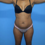 Tummy Tuck Before & After Patient #781