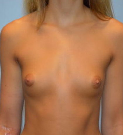 Breast Augmentation Before & After Patient #869