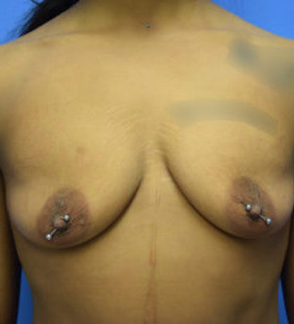 Breast Augmentation Before & After Patient #874