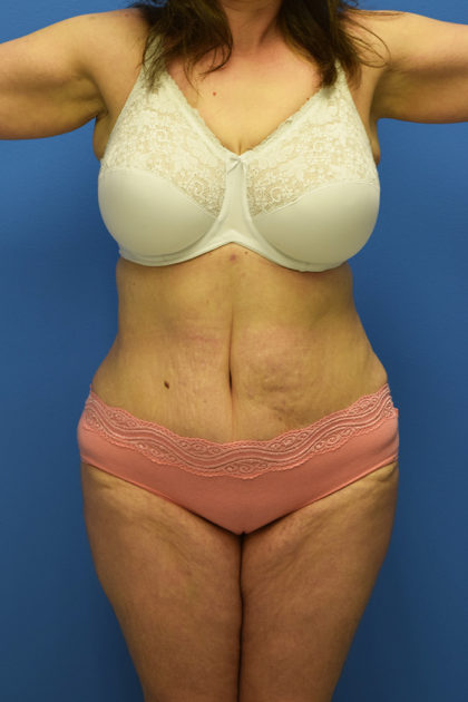 Tummy Tuck Before & After Patient #792