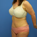 Tummy Tuck Before & After Patient #792