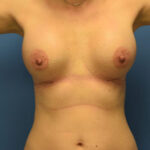 Breast Augmentation Before & After Patient #877