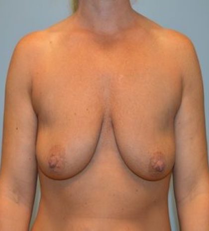 Breast Lift Before & After Patient #910