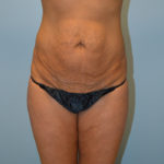 Tummy Tuck Before & After Patient #786