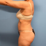 Tummy Tuck Before & After Patient #797