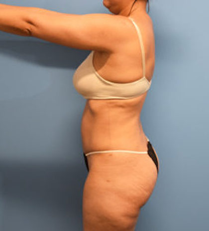 Tummy Tuck Before & After Patient #797
