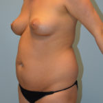 Liposuction Before & After Patient #941