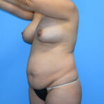 Tummy Tuck Before & After Patient #802