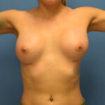 Breast Augmentation Before & After Patient #885
