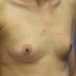 Breast Augmentation Before & After Patient #890