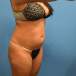 Liposuction Before & After Patient #950