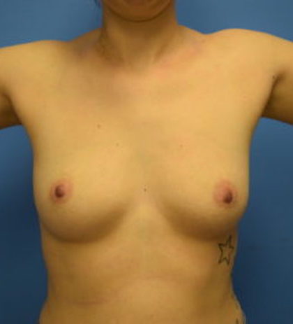 Breast Augmentation Before & After Patient #895