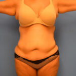 Tummy Tuck Before & After Patient #821
