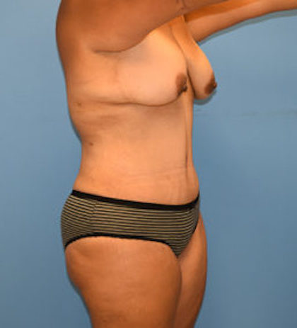 Tummy Tuck Before & After Patient #821