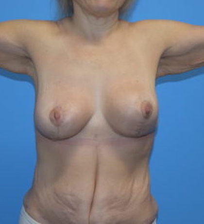 Breast Lift Before & After Patient #920