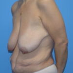 Breast Lift Before & After Patient #920
