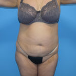 Tummy Tuck Before & After Patient #811