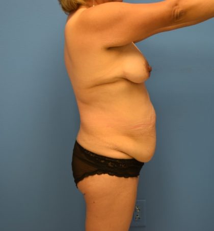 Tummy Tuck Before & After Patient #816