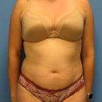 Liposuction Before & After Patient #955