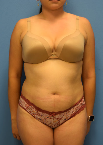 Liposuction Before & After Patient #955