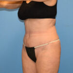 Tummy Tuck Before & After Patient #829