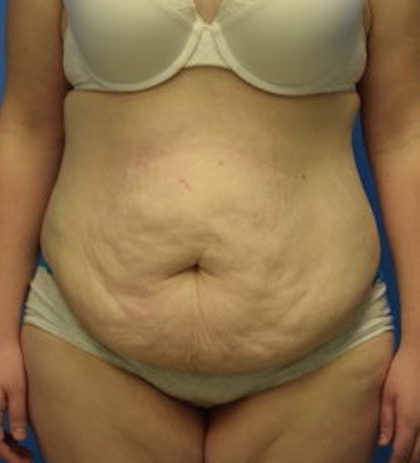 Tummy Tuck Before & After Patient #826