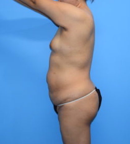 Tummy Tuck Before & After Patient #1077