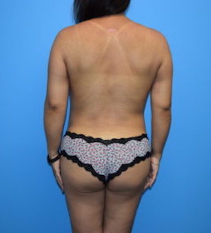 Tummy Tuck Before & After Patient #1077