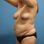 Tummy Tuck Before & After Patient #1090