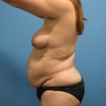 Tummy Tuck Before & After Patient #1090