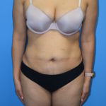 Liposuction Before & After Patient #1099