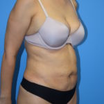 Liposuction Before & After Patient #1099
