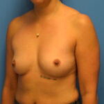 Breast Augmentation Before & After Patient #1118
