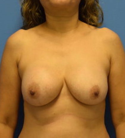 Breast Augmentation Before & After Patient #1119